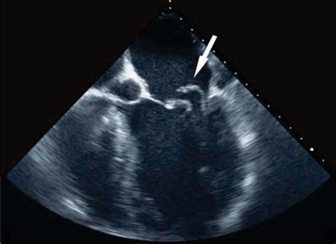 Transesophageal Echocardiogram Visualizing A Flail Posterior Leaflet Of