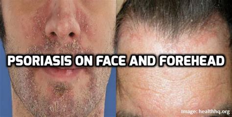How To Manage Psoriasis On Face And Forehead Psoriasis Self