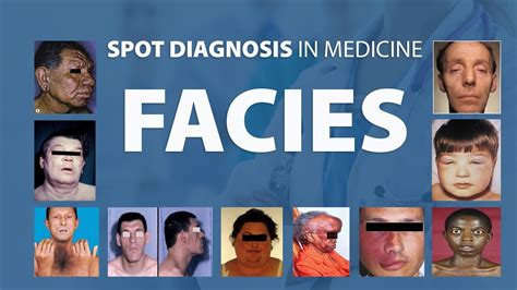 Adenoid Facies Features