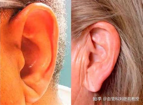 耳折痕是冠心病的征兆，这是真的吗？ 知乎