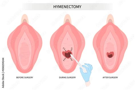 Surgery Procedure In Medical And Types Of Hymen For Hymenoplasty Repair Stock Vector Adobe Stock