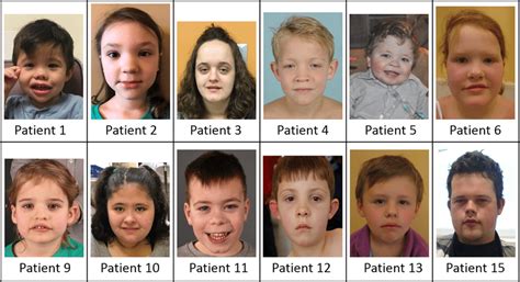 Clinical Portrait Photographs Of Patients With A Setd1a Pathogenic