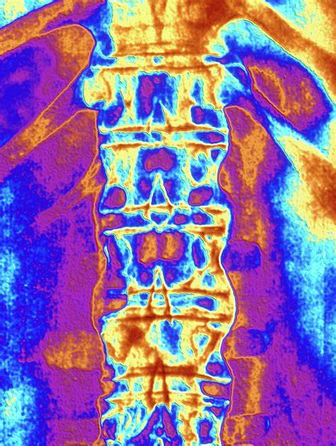 Coloured X Ray Of Spine In Ankylosing Spondylitis Photograph By Alfred