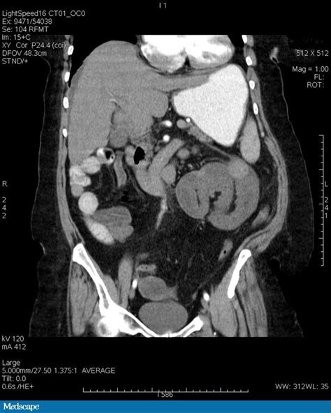 A 70 Year Old Woman With Progressive Abdominal Pain Page 2