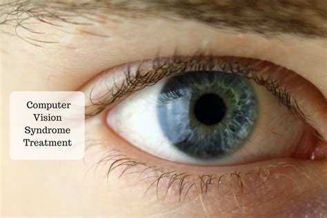 Computer Vision Syndrome Causes Symptoms And Treatment