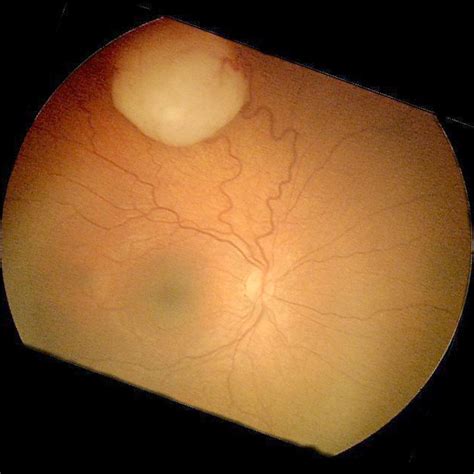 retinoblastoma physical examination wikidoc