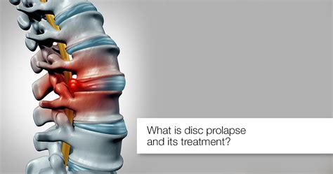 What Is Disc Prolapse Symptoms Causes Complications And Treatment