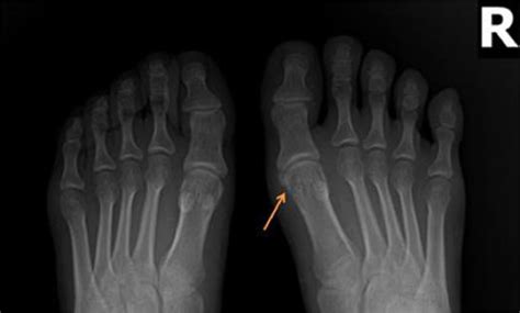 Arthroscopic Synovectomy And Excision Of A Sesamoid In The Management