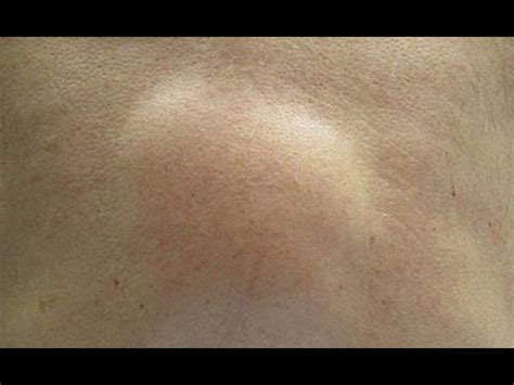 Skin Bumps Under Armpit