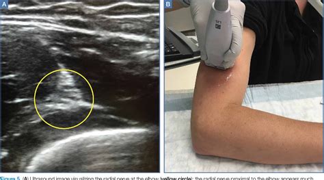 Figure 1 From Ultrasound Guided Ulnar Median And Radial Nerve Blocks