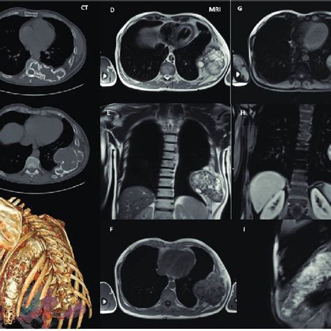 Positron Emission Tomography Computerized Tomography Images Showed
