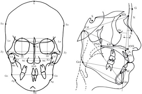 Lateral And Posteroanterior Cephalometric Tracing Showi Open I