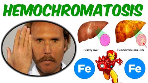Hemochromatosis Iron Overload Disorder Youtube