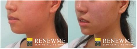 Renewme Skin Clinic Short Chin Filler And Mentalis Botox For Dimpling