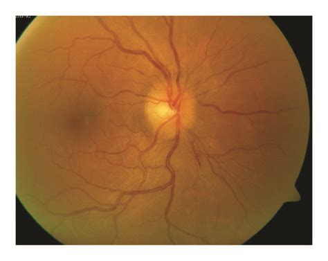 Fundus Photo Of The Right Eye Demonstrating Optic Nerve Head Edema