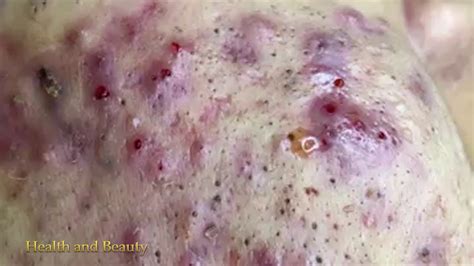 It helps to scrub the problem area gently. Ance Remove - Blackheads Removal - Best Pimple Popping ...