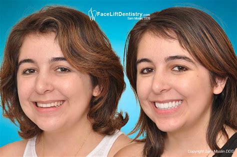 Check spelling or type a new query. Before and After Photos: Underbite, Overbite, Open Bite
