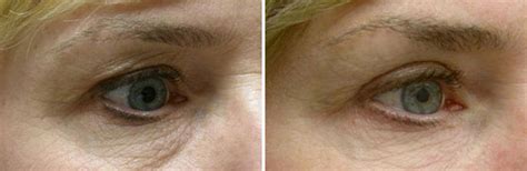 Maybe you would like to learn more about one of these? Eyelid Surgery Rhode Island | Blepharoplasty Providence