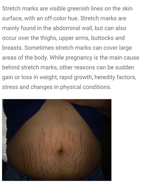 Reduce The Appearance Of Stretch Marks Naturally Musely