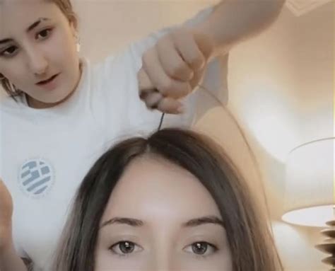 Scalp Popping Trend Is Back On Tiktok Doctors Say To Not Do This