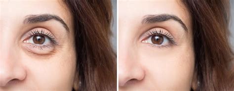 What Causes Eye Bags And How Can I Get Rid Of Them Joseph Fodero Md
