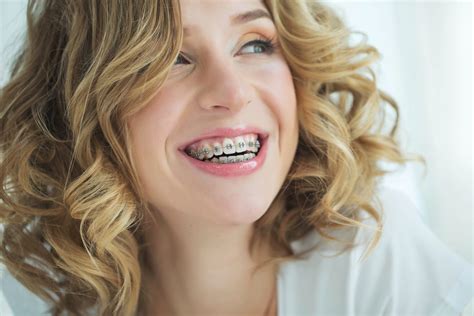 How To Best Prepare For Getting Braces