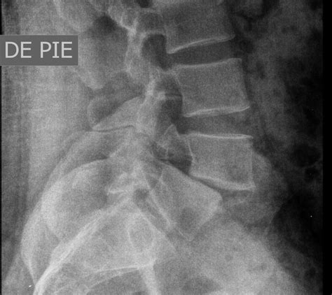 Spondylolisthesis Grade