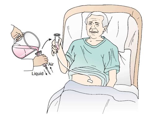 Nursing Process The Patient With A Gastrostomy