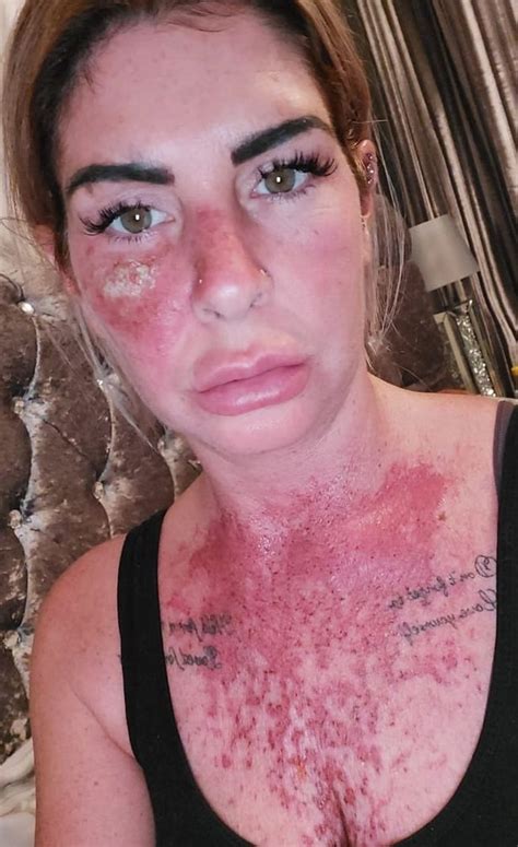Mum S Horrific Photos Reveal Exactly Why Sunbeds And Nasal Tanning Sprays Should Never Be Used