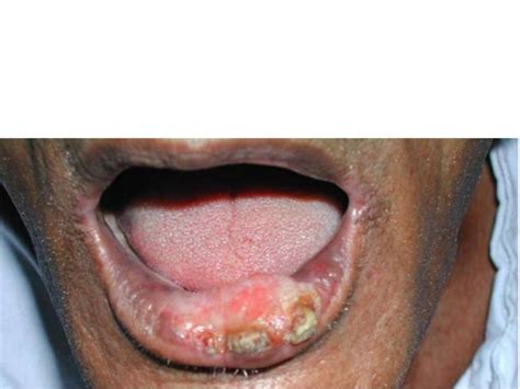 Oral Cavity Cancer