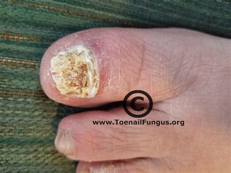 Toenail fungus remedies toenail fungus treatment cellulite treatment toe fungus cure eczema treatment fungus toenails candida treatment ayurvedic treatment fungal nail infection. 3 weeks of Lamisil - Toenail Fungus