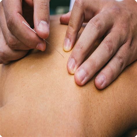 dry needling brisbane msk therapy clinic