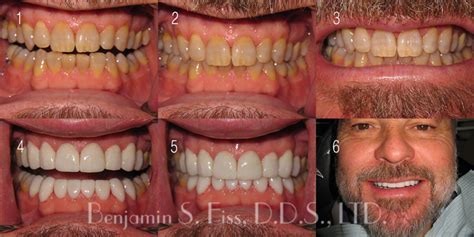 Before And After Full Mouth Porcelain Veneers In Chicago Il Chicago