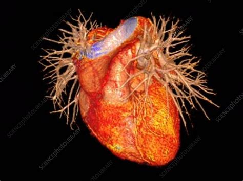 Human Heart Rotating 3d Ct Angiogram Stock Video Clip K0075226