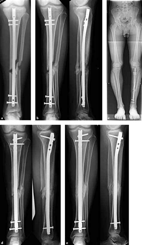 Tibial Shaft Fractures Musculoskeletal Key