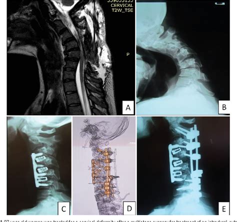 Figure 4 From Management Of Cervical Spine Deformity After Intradural