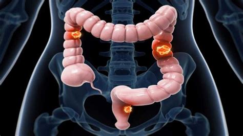What You Need To Know About Colorectal Cancer The New Times Rwanda