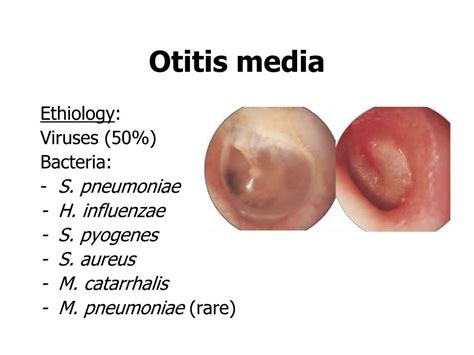 Ppt Infections Of The Upper Respiratory Tract Powerpoint Presentation