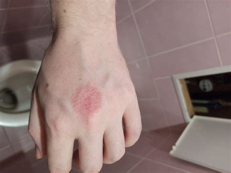 Красное пятно на руке расширяется Вопрос дерматологу 03 Онлайн