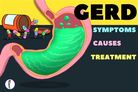 Gerd Treatment All You Need To Know