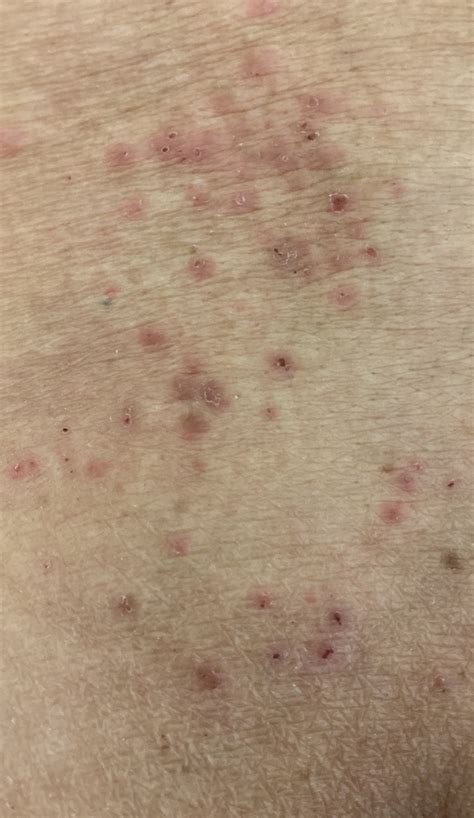Eczema Herpeticum Atopic Dermatitis Herpes Virus Infection Texas