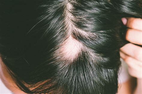 Aloe is an amazing home remedy for hair loss due to a dry or infected scalp. What Is Alopecia and What Is the Best Way to Treat It?
