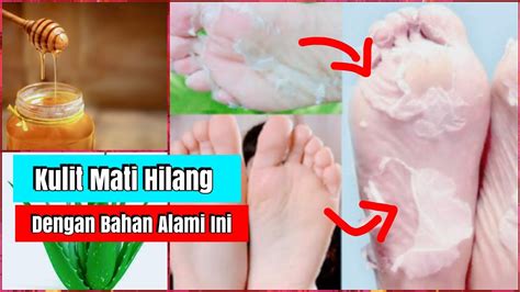 Saat saya mengunjungi puksemas, dokter menyarankan. Cara Menghilangkan Kulit Mati di Kaki Secara Alami - YouTube