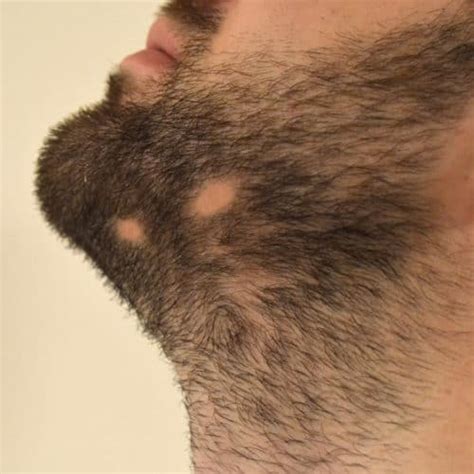 You might be able to reverse hair loss, or at least slow it. Alopecia Barbae: Signs, Symptoms, and Treatment - Bald ...