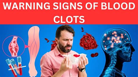 Top 12 Warning Signs Of Blood Clots Youtube