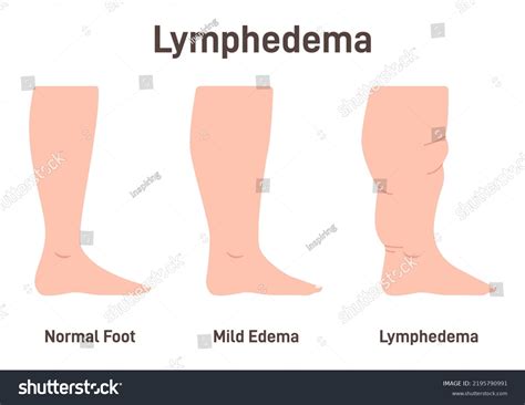 Lymphedema Stages Lymphatic System Dysfunction Disease Stock Vector