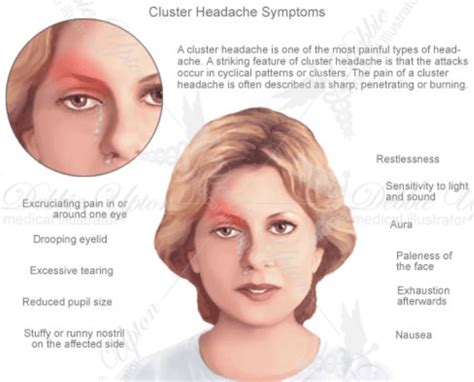 13 Common Causes Of Headache Behind Left Eye