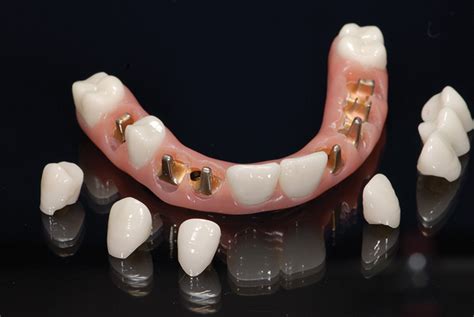 Hybrid Zirconia Dental Implants Zirconia Hybrid Dentures