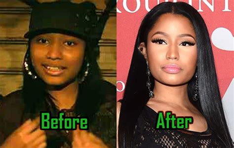 Nicki Minaj Before And After The Surgery Telegraph