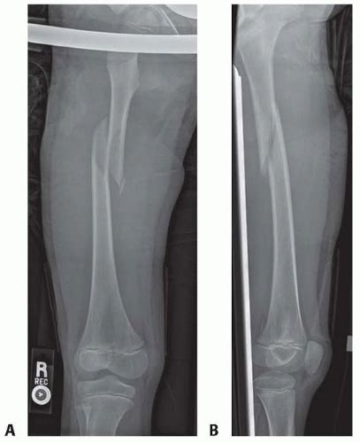 Flexible Intramedullary Nailing Of Femoral Shaft Fractures